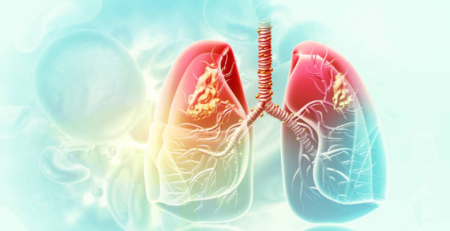 SPP alerta para estigma associado à tuberculose