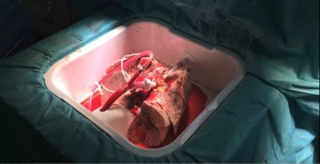 Operação de recuperação e avaliação pulmonar ex vivo é possível no CHULC