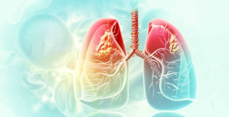 Cemiplimab: financiamento aprovado para tratamento em 1.ª linha de doentes com CPNPC, PD-L1 >50 %