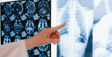 SPP pretende via verde para diagnóstico de cancro do pulmão