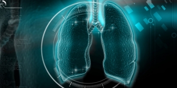 PACIFIC: benefício de PFS com anti-PD-L1 no cancro do pulmão em estadio III