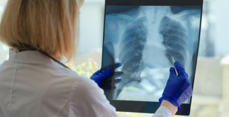 Fibrose pulmonar: uma patologia subdiagnosticada e progressiva, em que o diagnóstico precoce é fundamental