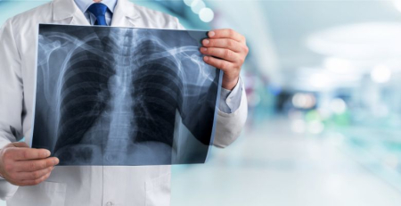 Estudo confirma que rastreio do cancro do pulmão em Portugal é um investimento que salva vidas e é custo-efetivo