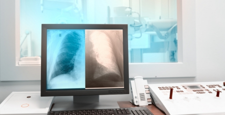 Cancro do pulmão: Estudo revela benefício de sobrevivência global a longo prazo no tratamento com pembrolizumab