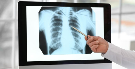 Pulmonale considera urgente rastreio nacional do cancro do pulmão