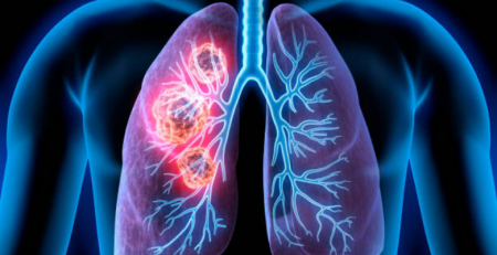 Infarmed aprova financiamento de pembrolizumab em combinação com carboplatina e com paclitaxel ou nab-paclitaxel