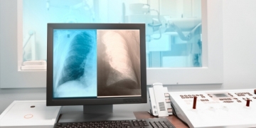 SPP alerta: todos os profissionais de saúde devem estar envolvidos na deteção de casos de tuberculose