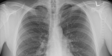 CPCNP: quimioterapia pembrolizumab-pemetrexed-platina reduz risco de morte para metade em comparação com quimioterapia isolada