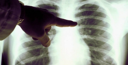 Investigadores desenvolvem técnica não invasiva para caracterizar cancro do pulmão